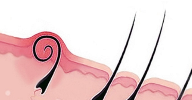 Batık Nedir, Nasıl Tedavi Edilir? 