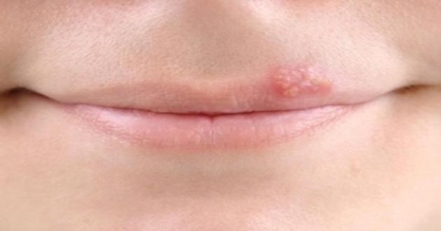 Uçuk Neden Çıkar, Nasıl Geçer?