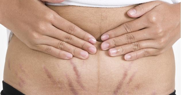  Karın Çatlakları İçin Etkili Yöntemler