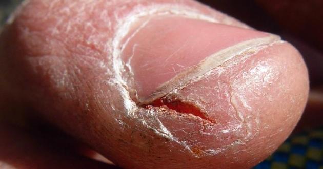 Parmak Ucu Çatlaklarına Ne iyi Gelir