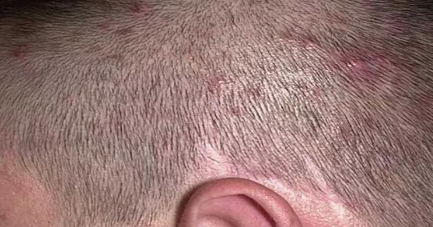 Saç Derisindeki Sivilcelerin Nedenleri