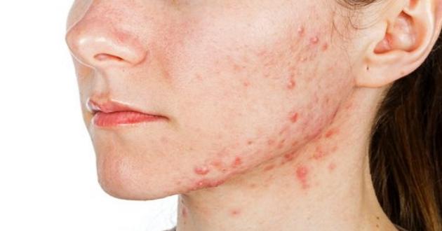 Tahriş Olan Cilde Ne İyi Gelir