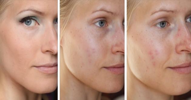 Sivilce İzlerini Yok Eden Çok Etkili Maske Tarifleri