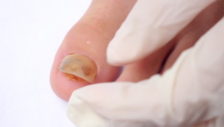 Tırnak Batması Nasıl Geçer ?