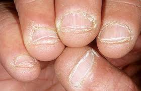 Tırnak Yemenin Nedenleri Nelerdir?