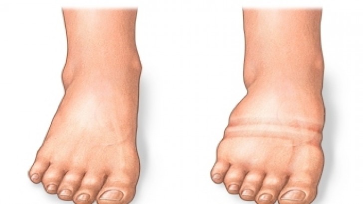 Ödem Nedir? Ödem Söktürücü Çay Tarifleri