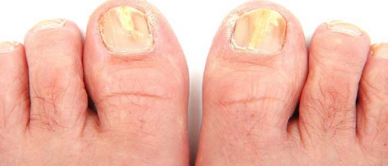 Tırnak Mantarı Neden Olur? Tırnak Mantarı Nasıl Geçer?