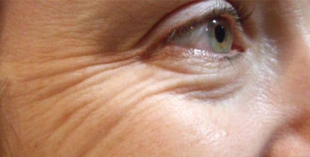 Kaz Ayaklarından Kurtulmanın Yolları Nelerdir?