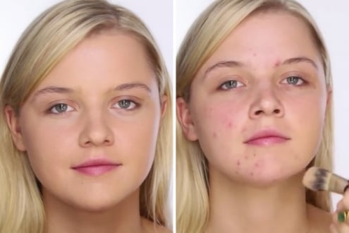 Sivilceler Makyajla Nasıl Kapatılır?