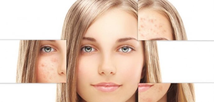 Sivilce İzleri Nasıl Geçer