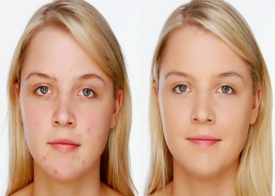 Sivilce İzleri Nasıl Geçer? Sivilce Lekeleri İçin Doğal Yöntemler