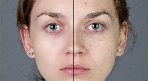 Yüzdeki lekeler nasıl geçer? Evde uygulayabileceğiniz doğal çözümler