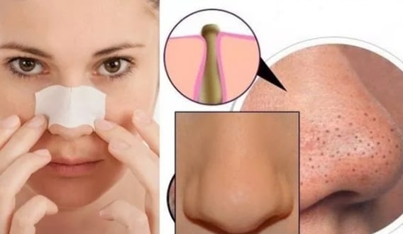 5 Farklı Siyah Nokta Temizleme Yöntemi