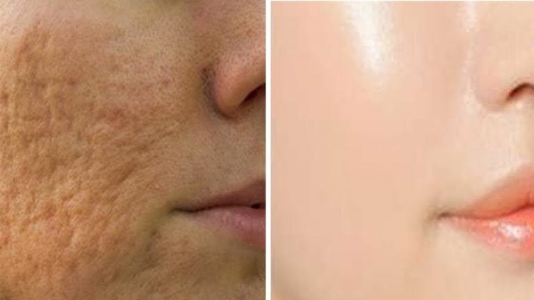 Gözenekleri Temizlemek İçin Doğal Maske