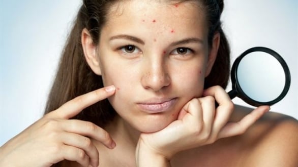 Yüzdeki Sivilce Nasıl Geçer?