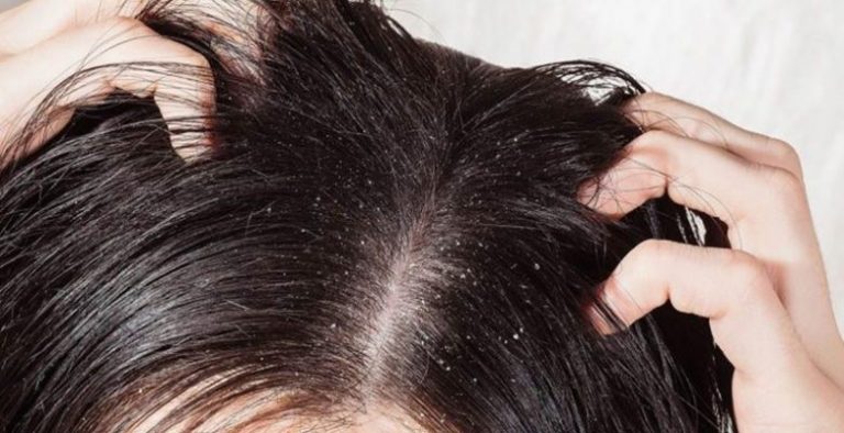 Kepeğe Karşı Doğal Saç Maskeleri