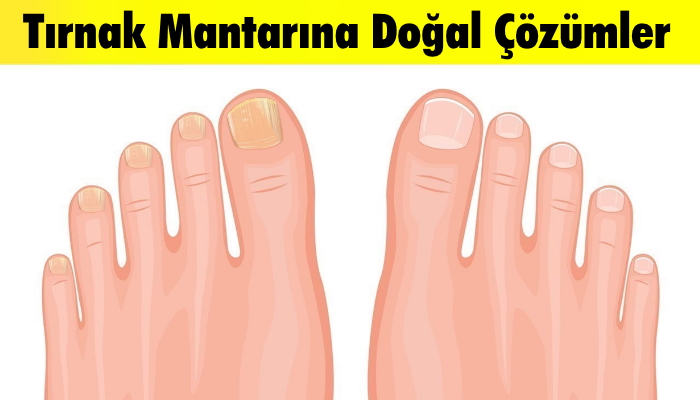 Tırnak Mantarını Geçiren Çok Etkili Doğal Yöntemler