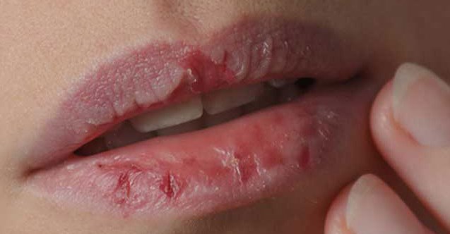 Dudak Çatlaması Nasıl Geçer