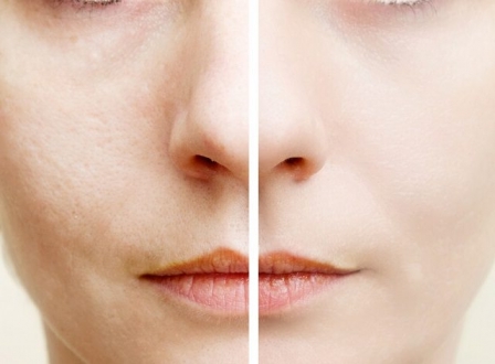 Ciltteki Gözenekleri Sıkılaştırmak İçin Çok Etkili Doğal Yöntemler