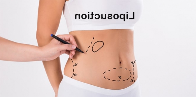 Liposuction Nedir ? Nasıl Uygulanır?