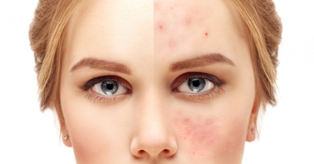 Sivilce Nedir? Neden Olur? Sivilceler İçin Çok Etkili Yöntemler