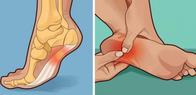 Topuk Dikeni Neden Olur? Nasıl Geçer?