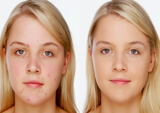 Sivilce Yaralarını Geçirmek İçin Etkili Maske Tarifleri