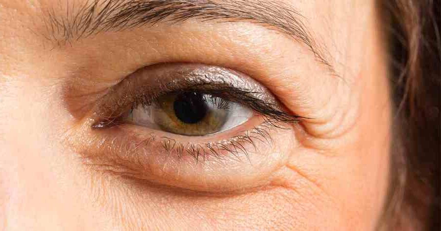 Göz Altı Torbaları İçin Doğal Çözüm Önerileri