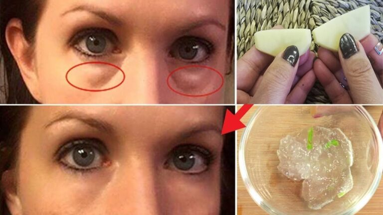 Göz Altı Torbalarını Gidermek İçin Maske Tarifleri